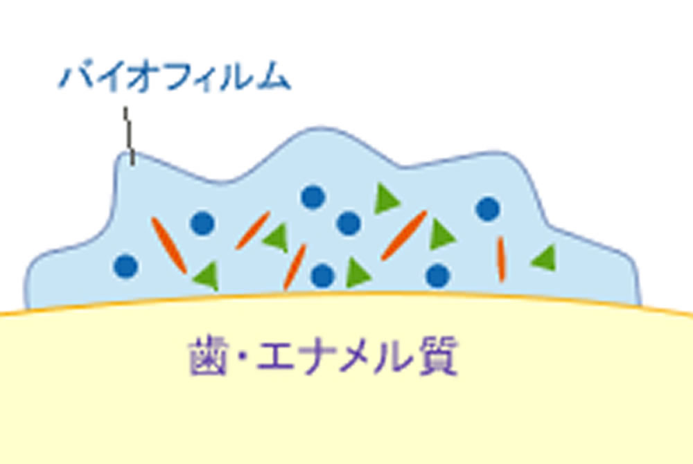 虫歯・歯周病の予防