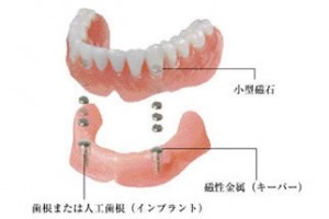 マグネットデンチャー