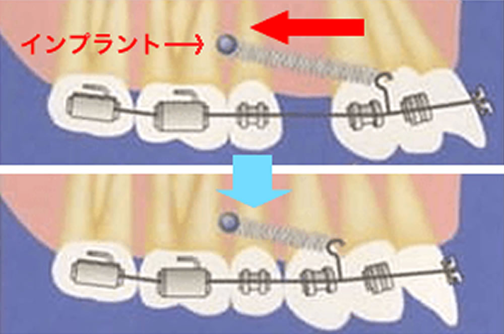 インプラントアンカー矯正