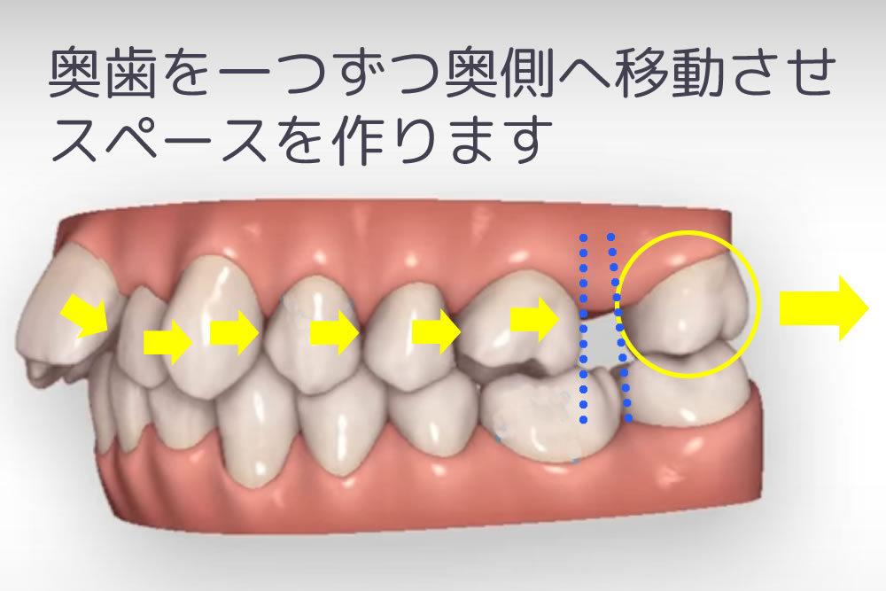 歯を遠心移動