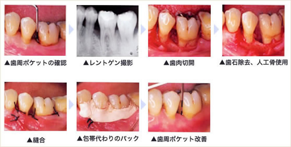 歯周病症状が重度の場合