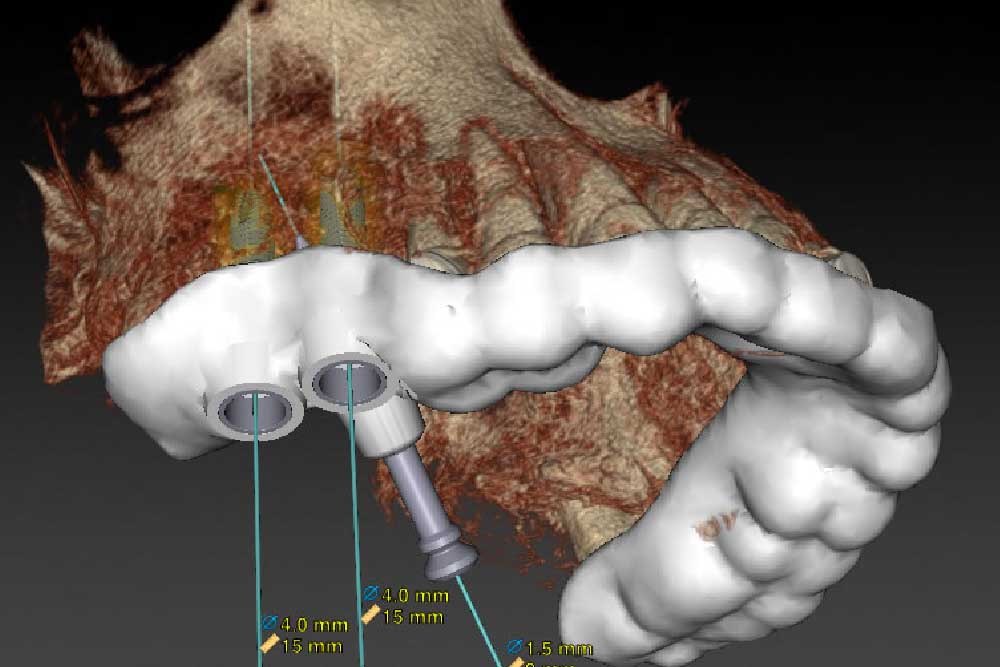 インプラントガイド